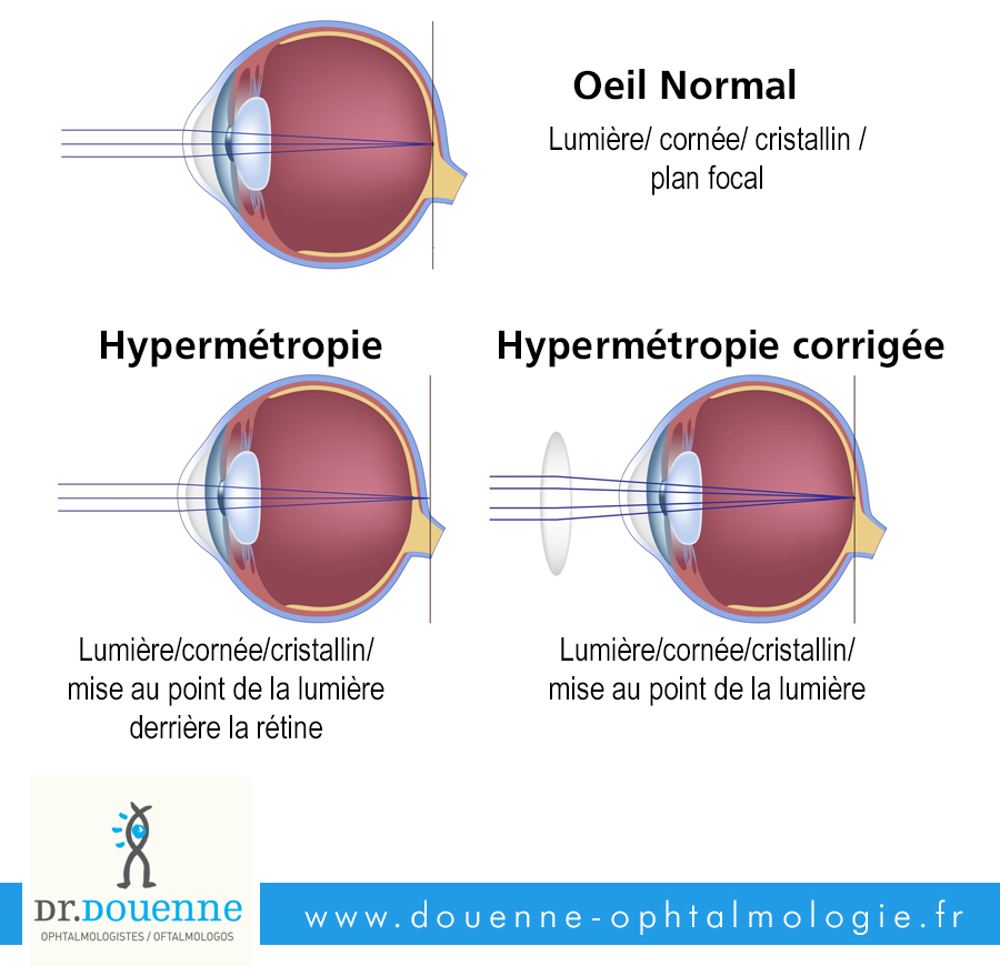 L'hypermtropie - chirurgie de l'oeil