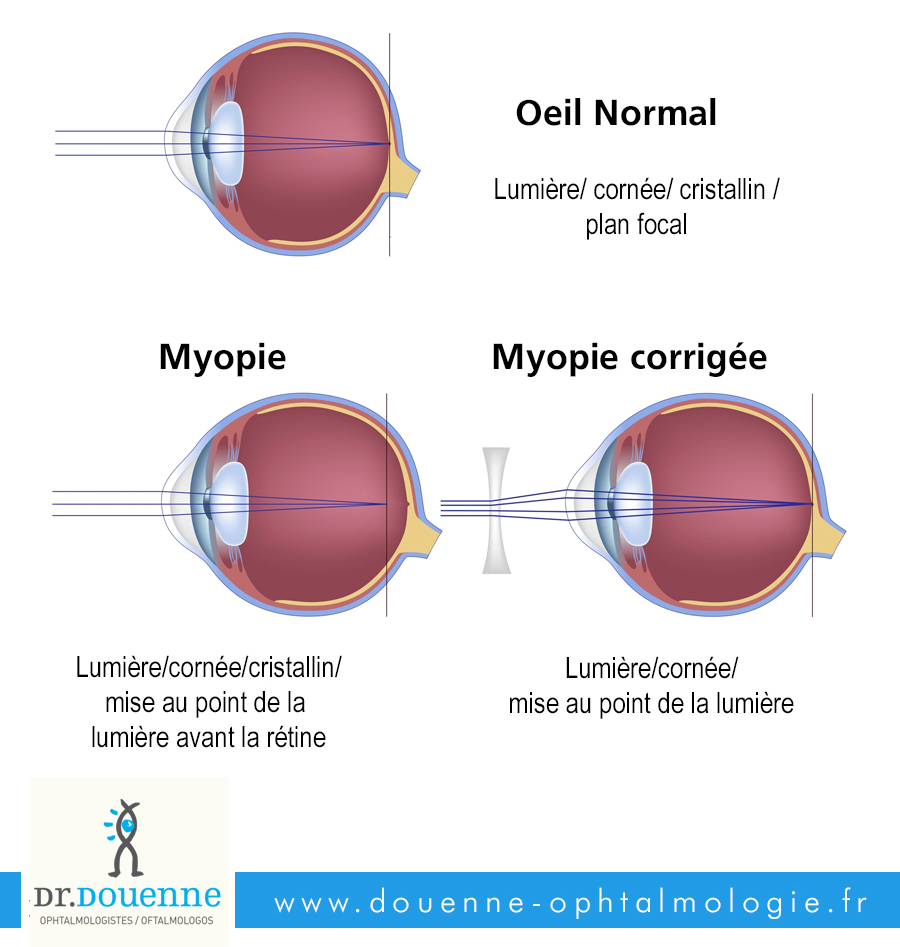 La Myopie traitement chirurgie de l'oeil