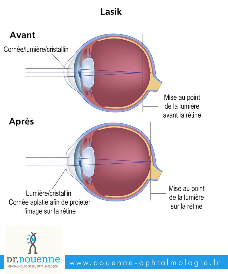 Myopie - chirurgie de l'oeil