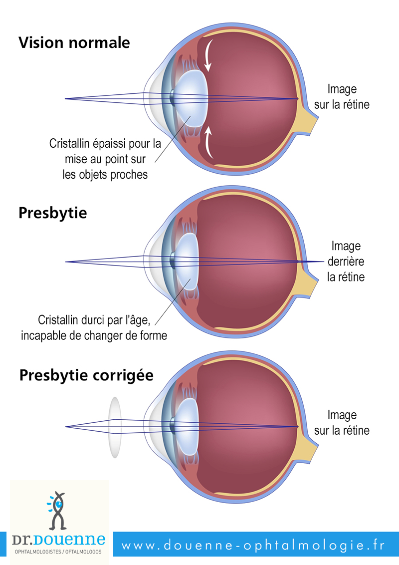 LA PRESBYTIE - chirurgie de l'oeil