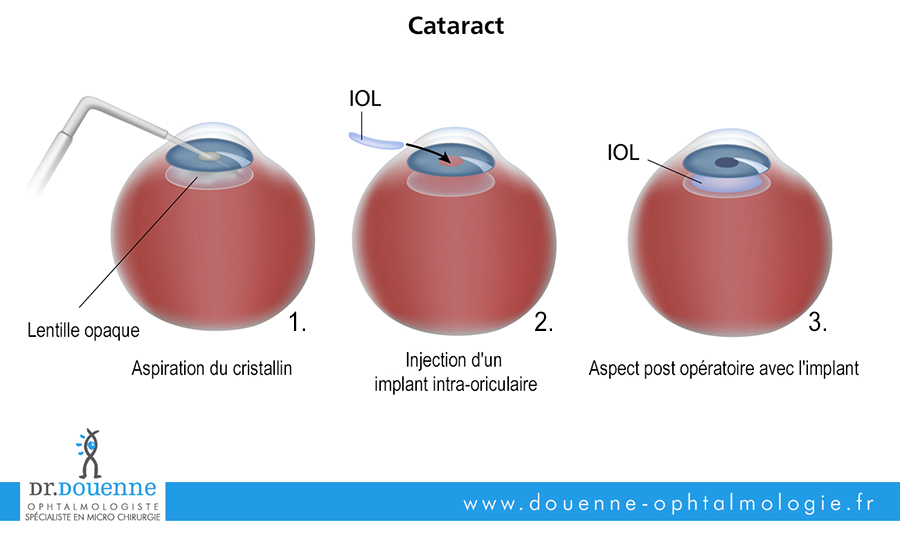 Cataracte - chirurgie de l'oeil