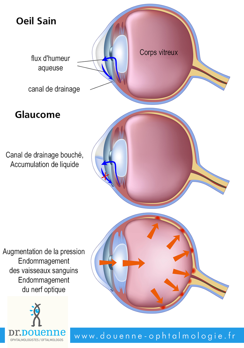LE GLAUCOME - chirurgie de l'oeil