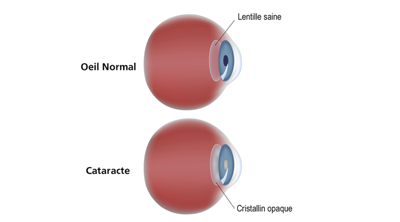 Chirurgie de la Cataracte à Biarritz