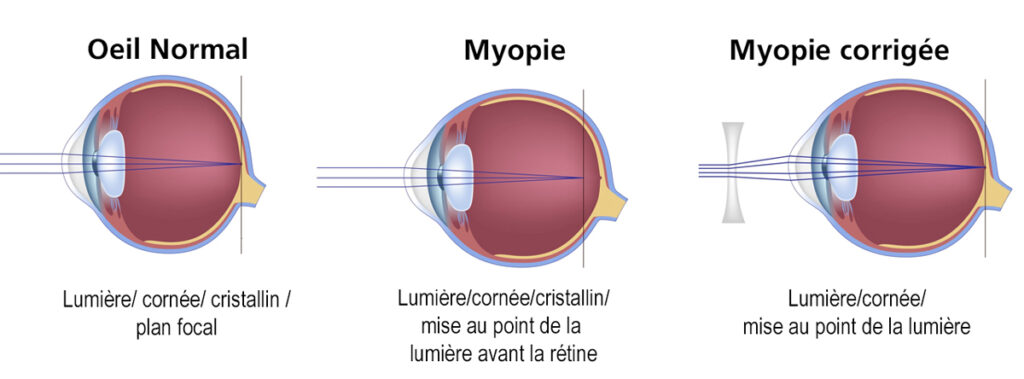 Chirurgie de la Myopie à Biarritz
