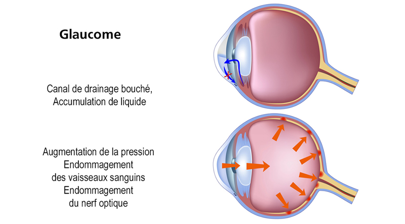 chirurgie du Glaucome à Biarritz – LuzClinic