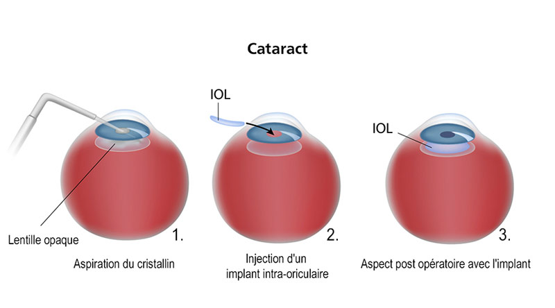 Chirurgie de la Cataracte à Biarritz