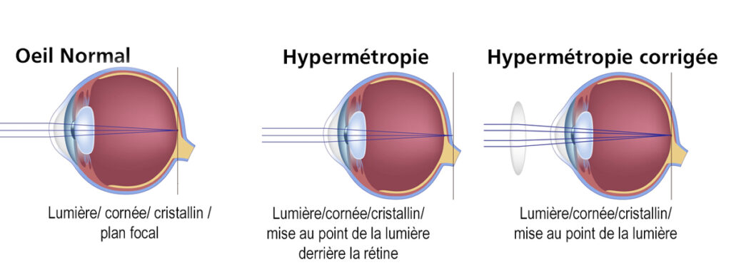 Chirurgie de l'Hypermétropie à Biarritz